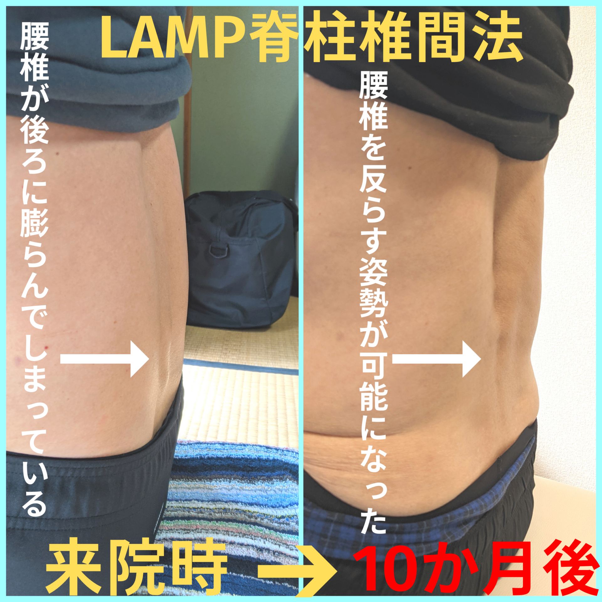 LAMP脊柱椎間法　10か月後　あゆは整体院　腰痛　大津市-2